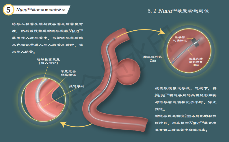 泰杰伟业公司动脉栓塞装置系统使用手册设计图9